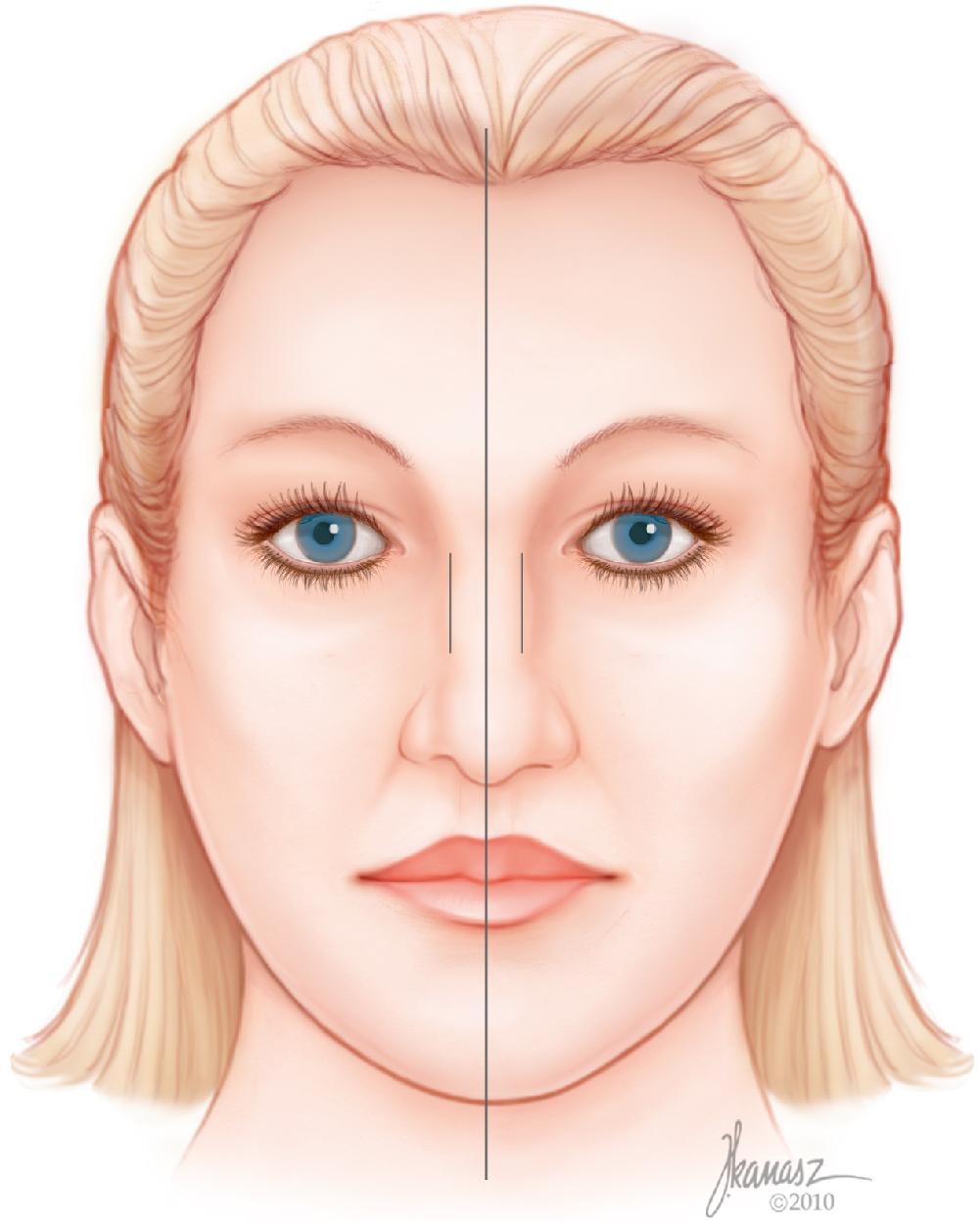 Fig. 28.2, The midpoint between the medial canthi is connected to the midpoint of the upper lip (philtrum dimple). Two smaller vertical lines are then drawn 7 mm from this center line.