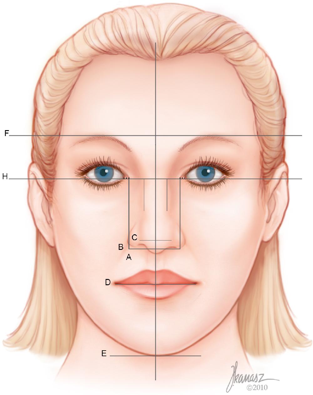 Fig. 28.4, A horizontal line is drawn touching the lower border of the alar base ( B ). A second line is then placed 5 mm above this line ( C ). A third horizontal line connects the oral commissures ( D ), and a fourth line is placed along the lower border of the chin ( E ). A horizontal line is then drawn passing through the caudal border of the eyebrows ( F ).