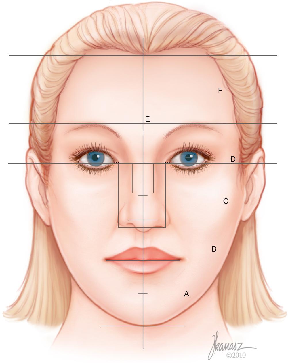 Fig. 28.5, The distance between these lines is then measured to show the proportions of the face. The measurements include the chin line to the stomion ( zone A ), the stomion to the alar base ( zone B ), the alar base to the medial canthi ( zone C ), the intercanthal line to the eyebrow line ( zone D ), and finally the distance between the medial canthi ( zone E ). Ideally, D × 2 = C = B × 2 = A = E.