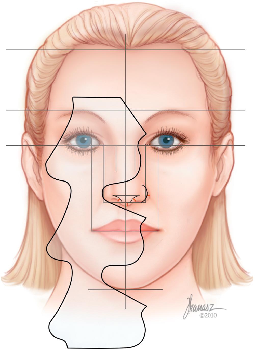 Fig. 28.8, The segment of the template between the two chin outlines is used to draw the outline of the optimal alar base.