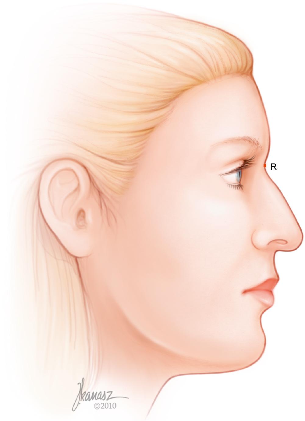 Fig. 28.9, The first step in analysis of the profile is to define the nasofrontal groove. If this groove is too shallow or too deep, the radix (R) is considered to be 4 to 6 mm deep in the horizontal plane and at the level of the upper tarsal crease in a straight gaze.