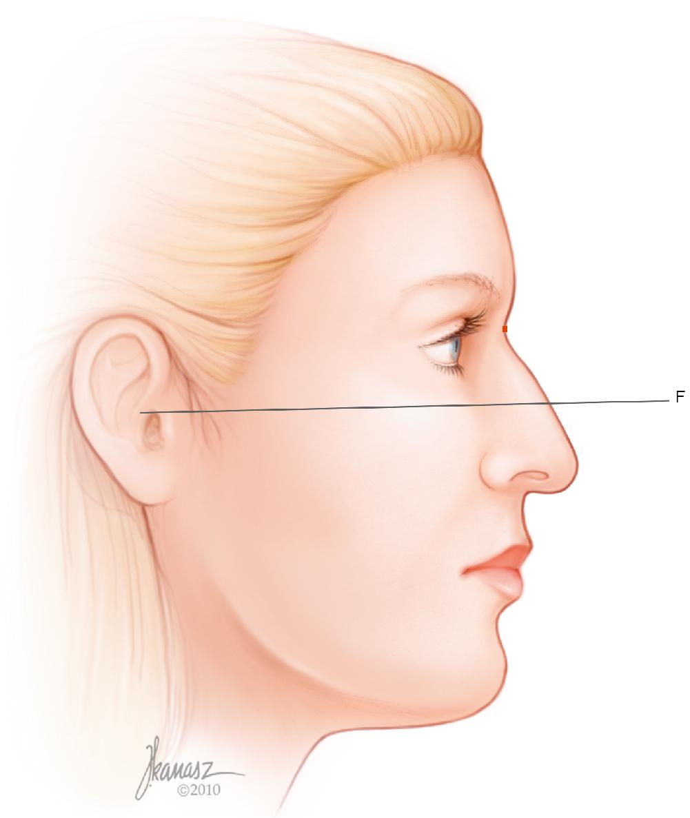 Fig. 28.11, The upper border of the tragus is connected to the infraorbital rim, as marked on the patient before photography. This line is continued past the nasal outline (Frankfurt horizontal plane; line F ).