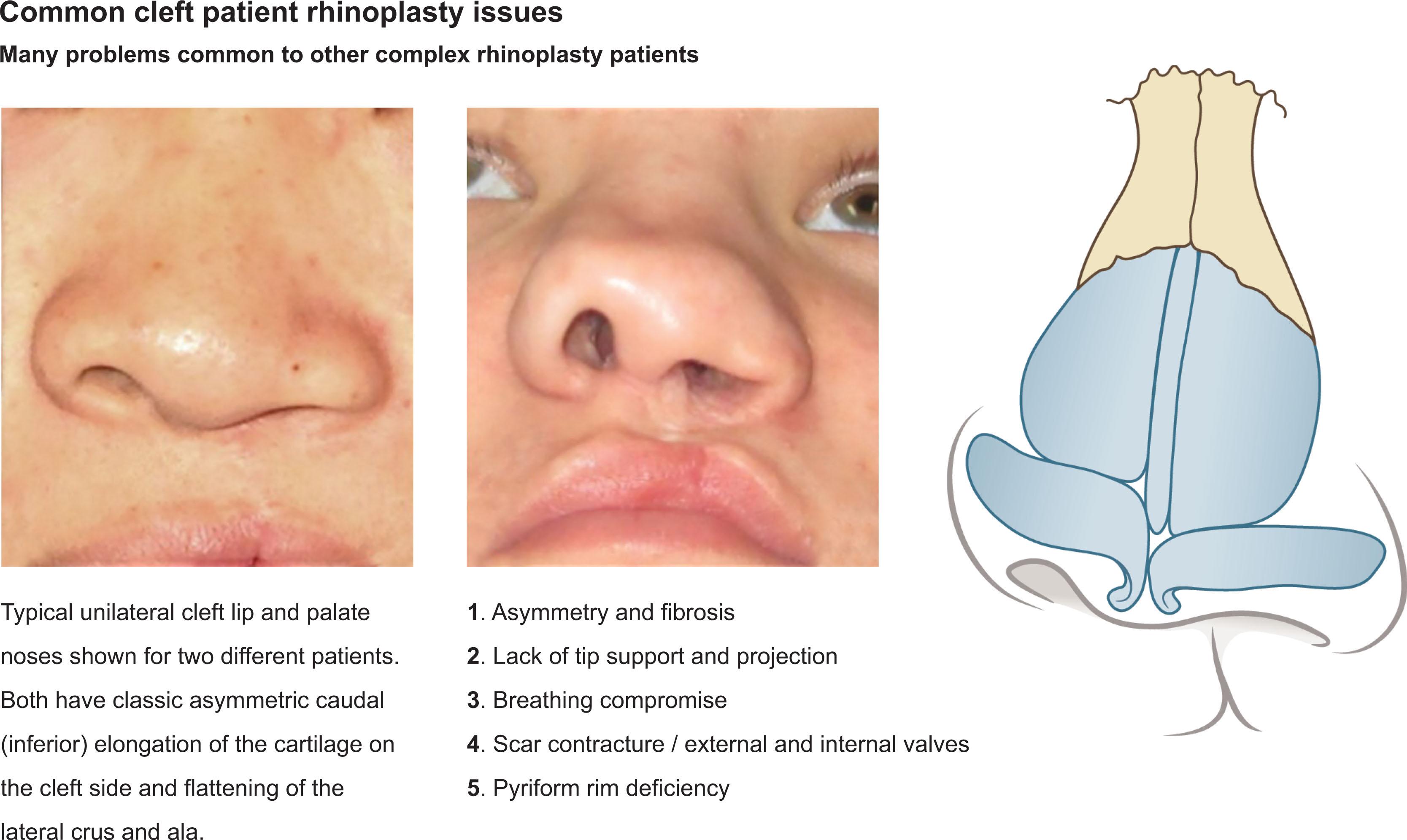 Fig. 74.1, Cleft lip and palate nasal issues are listed. Classically, malformed lower lateral cartilages exist on the side of the cleft that contributes to the deformity of the nasal tip, causing it to be flat and blunt.