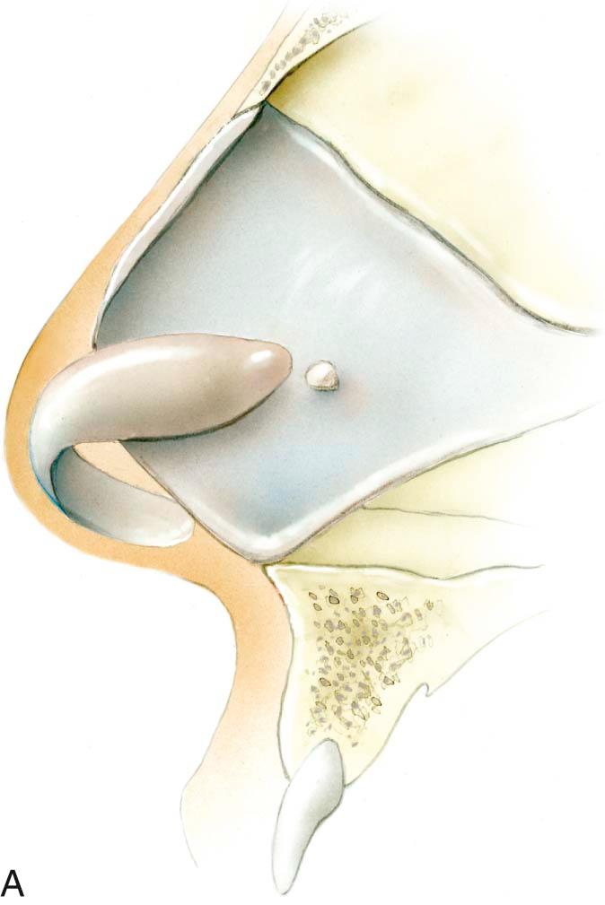Figure 33-1, A, Profile of an aging patient. Note the underprojection of the nasal tip. B, Placement of a caudal extension graft with septal cartilage overlapping the existing nasal dorsum. C, Note the increased tip projection to create a straight dorsal profile.