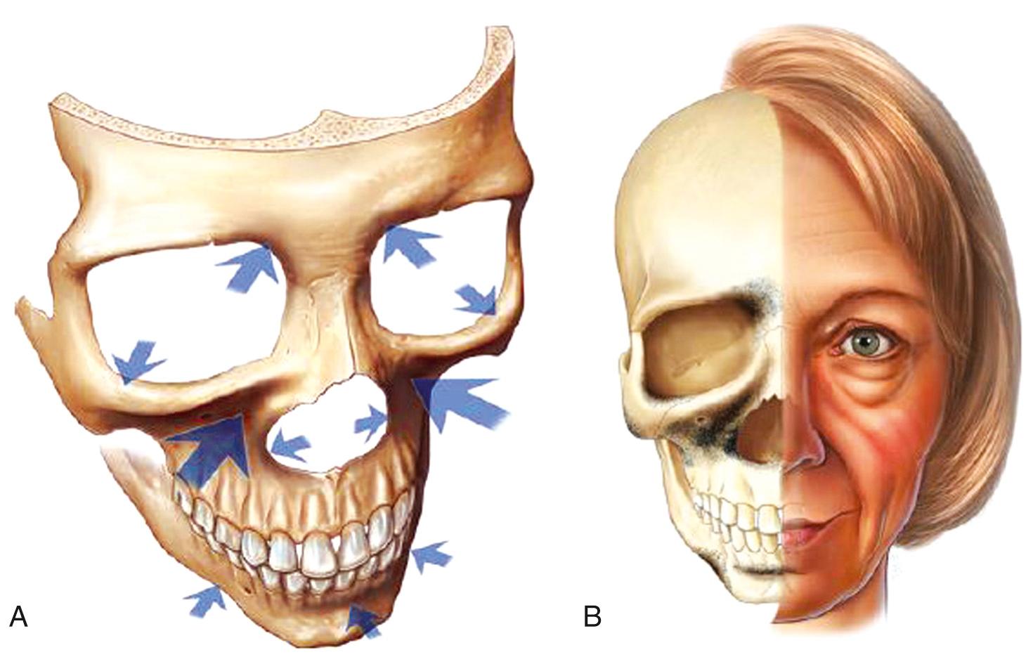 Fig. 24.1, The aging facial skeleton.