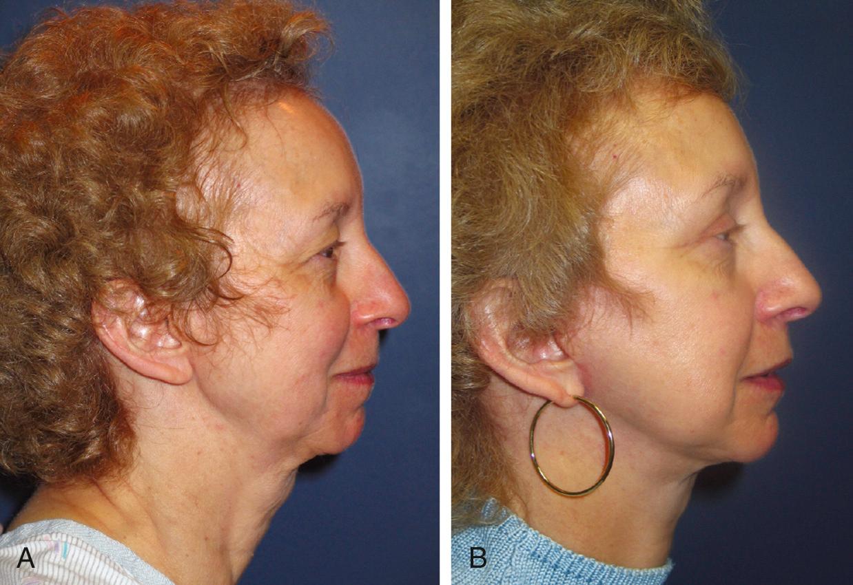 Fig. 24.2, (A) Lateral view demonstrates a blunted cervicomental angle with skin laxity, submental adiposity, and a weak mentum. (B) Improved cervicomental angle following cheek-neck rhytidectomy with submentoplasty.