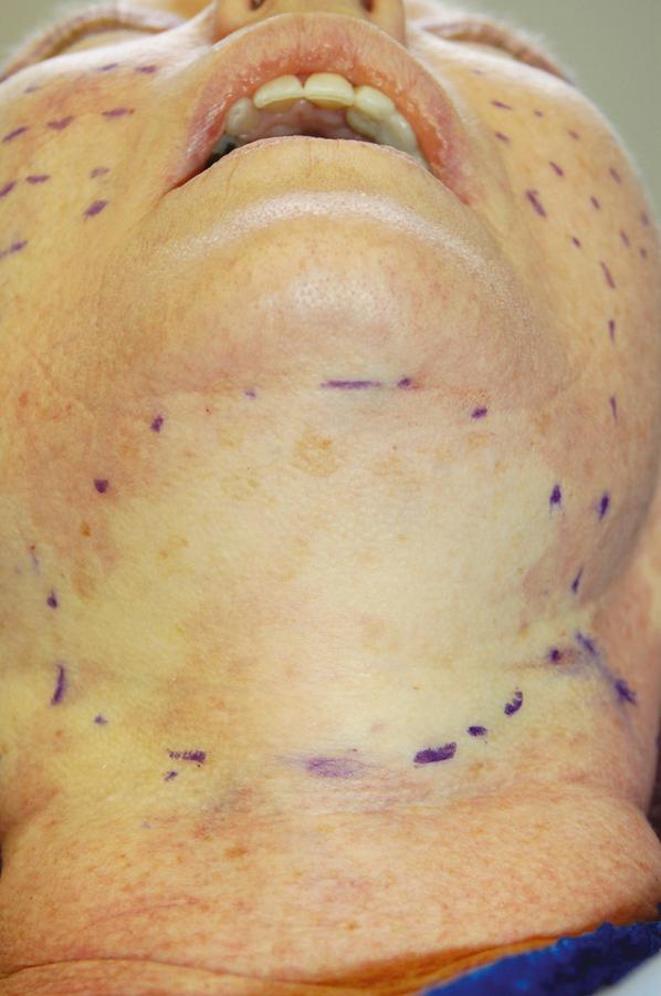 Fig. 24.5, Submental markings outline the extent of dissection to be performed during submental liposuction.