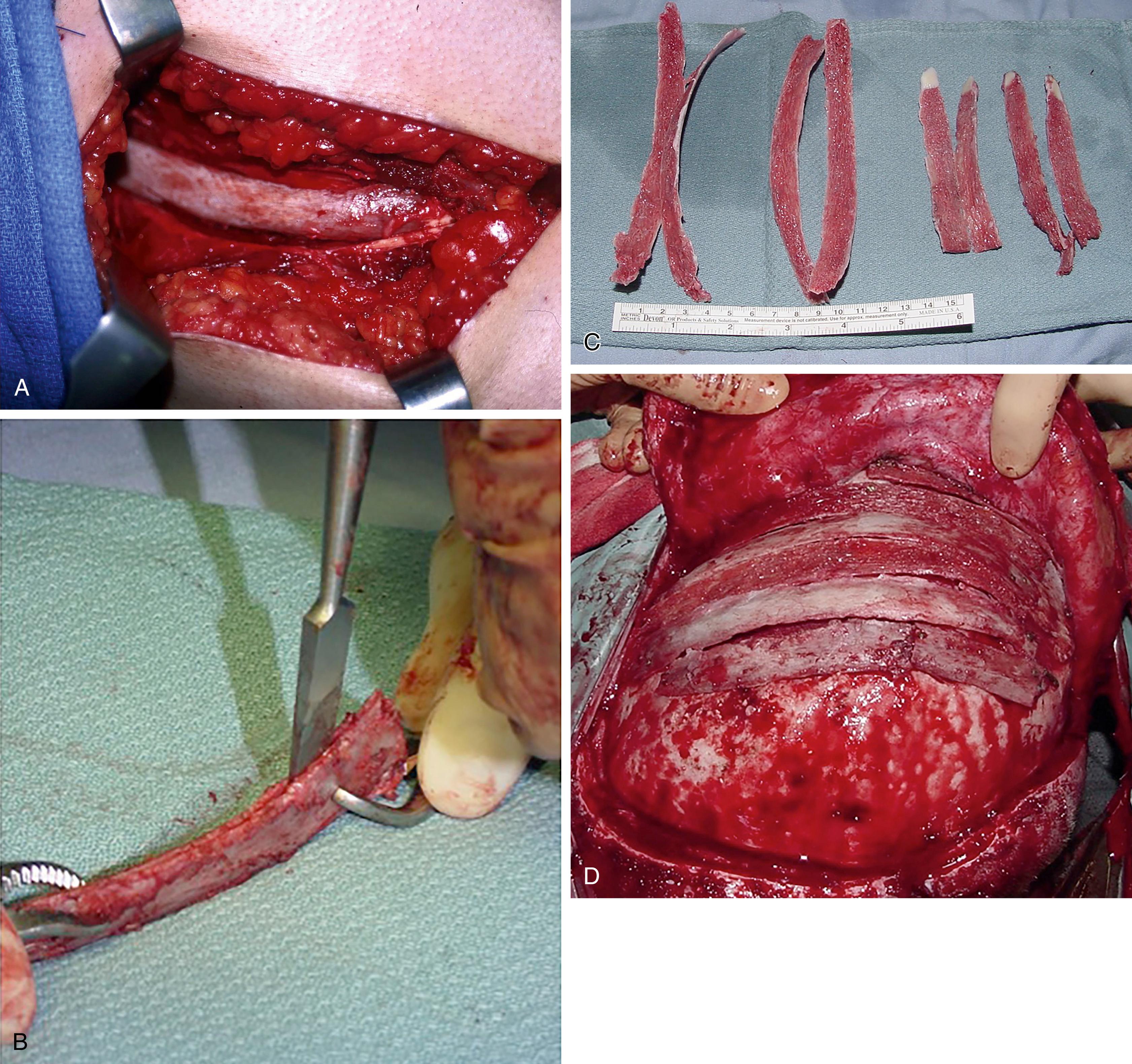 Fig. 176.1, Rib bone graft harvest.