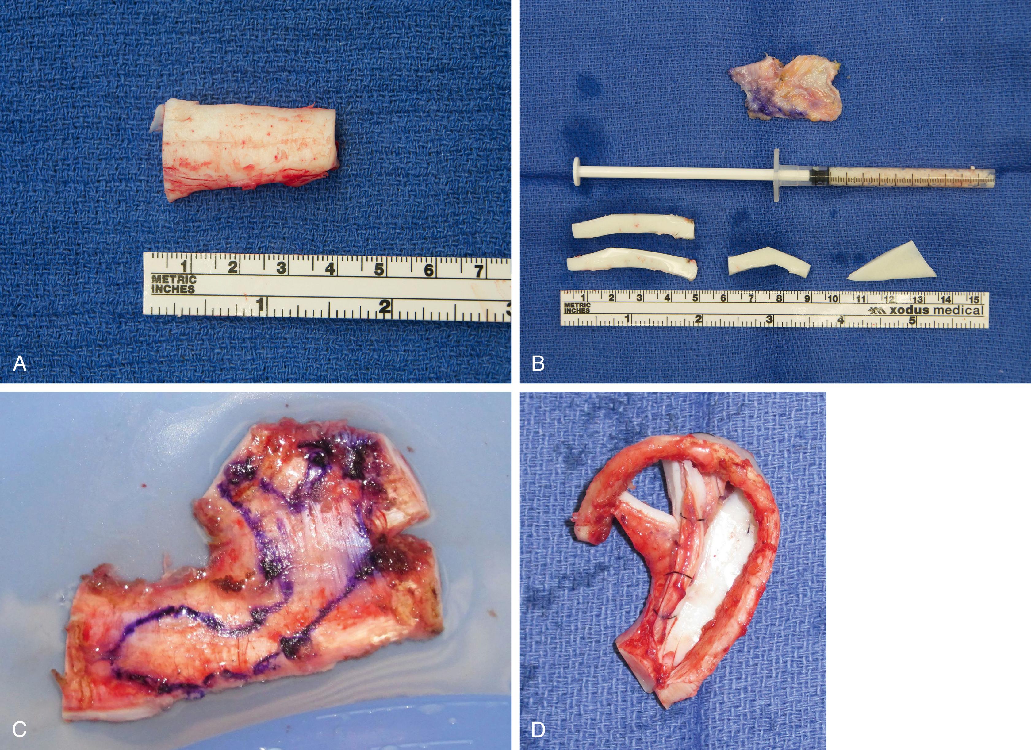 Fig. 176.2, Costal cartilage grafts for rhinoplasty and microtia reconstruction.