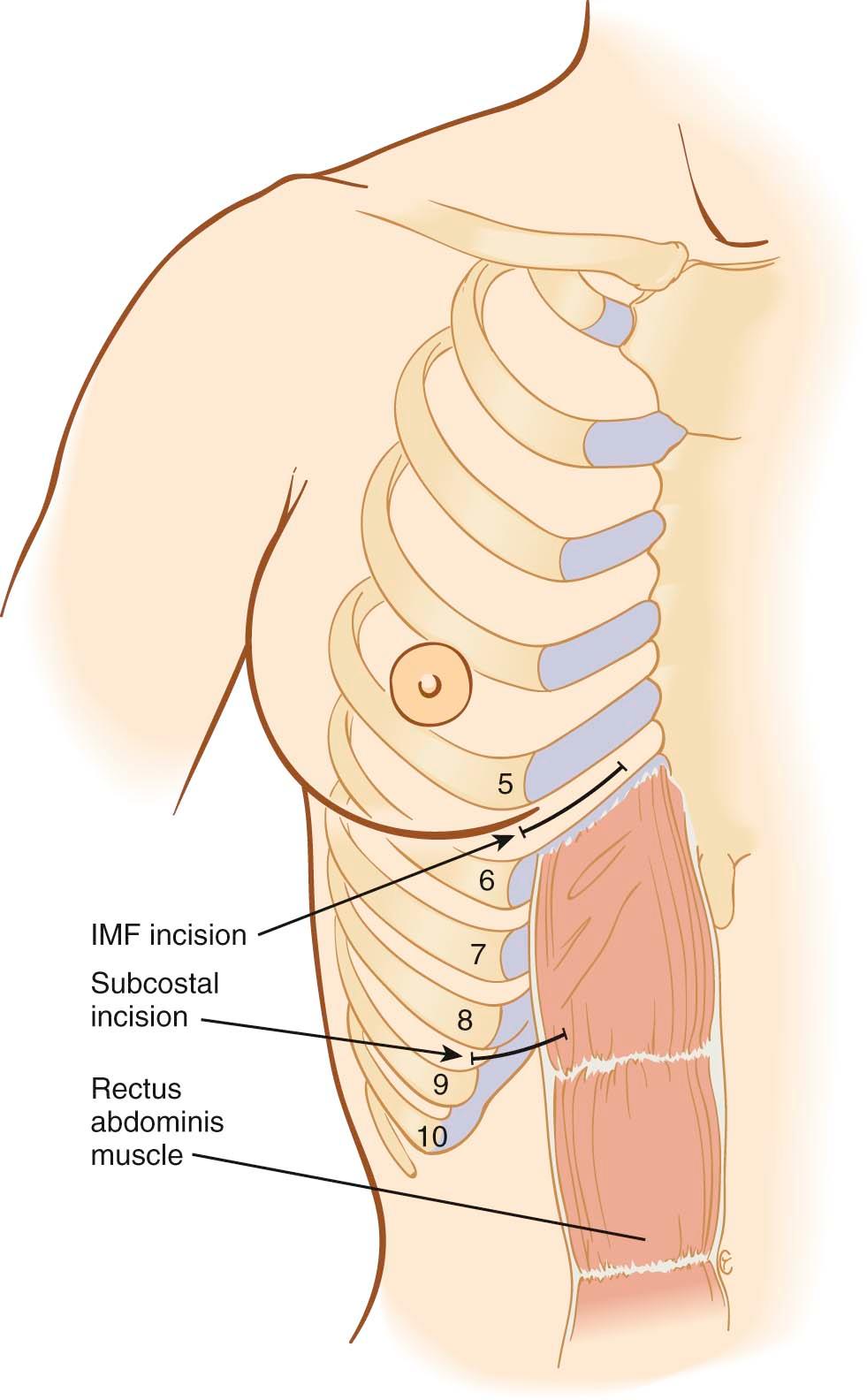 Figure 15-1, Inframammary fold and subcostal access incisions.