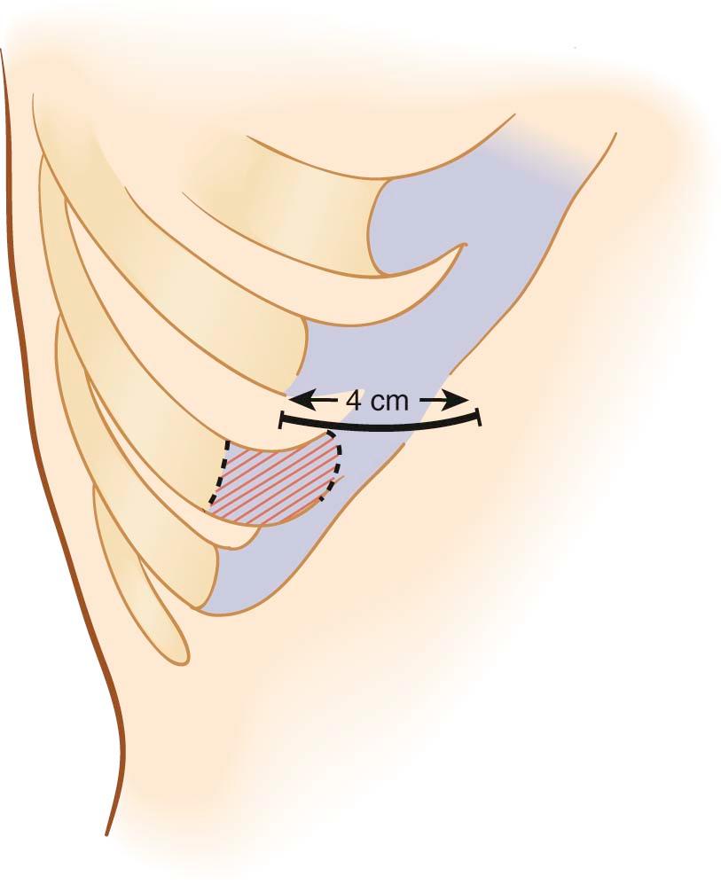 Figure 15-2, Subcostal incision closed with ninth rib cartilage and a portion of eighth rib cartilage.