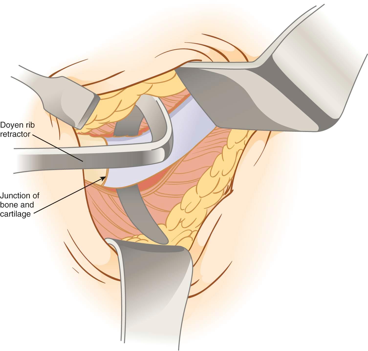 Figure 15-5, Doyen retractor facilitates rib dissection off of the posterior perichondrium.