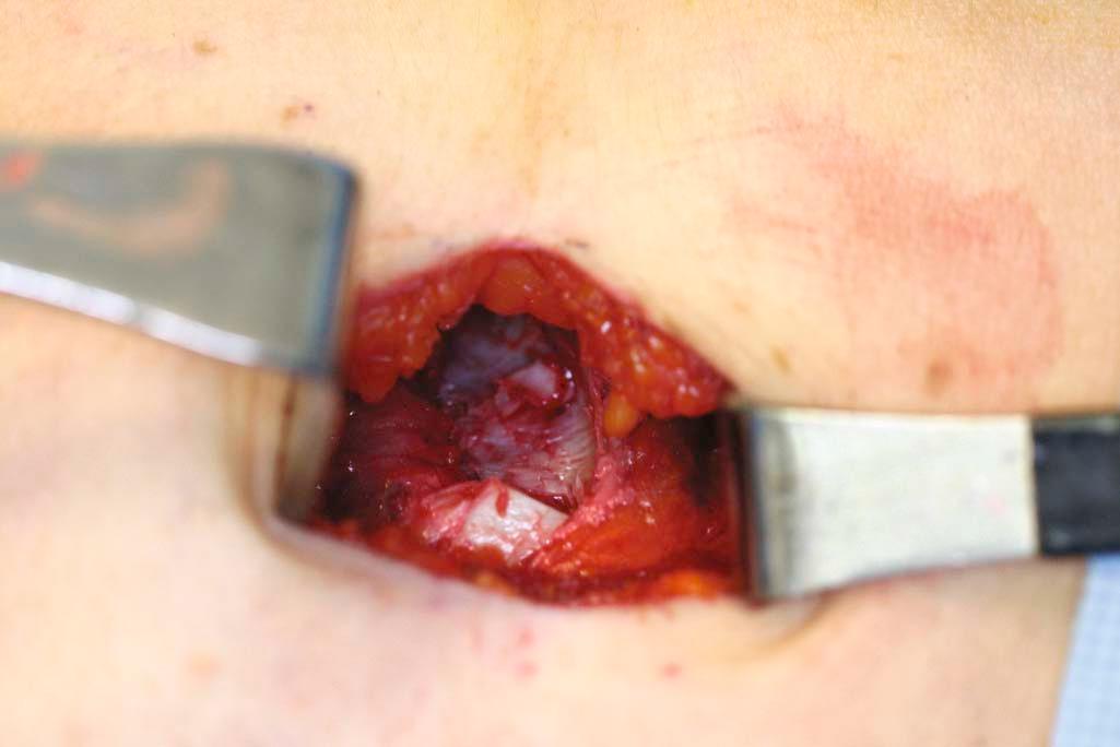 Figure 15-6, Posterior perichondrium with rib removed; ready for pleural integrity check.