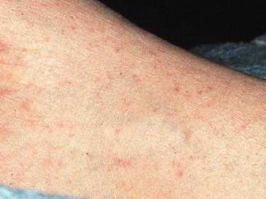 Figure 19-1, Petechial skin rash in RMSF. The gross pathology of rickettsial vasculitis in the dermis presents initially with macules and then maculopapular lesions that blanch owing to the underlying vascular dilation as the main abnormality. In some cases, petechiae develop when vascular injury from vasculitis results in extravasation of erythrocytes into the dermal connective tissues and a nonblanchable lesion and sometimes palpable purpura.