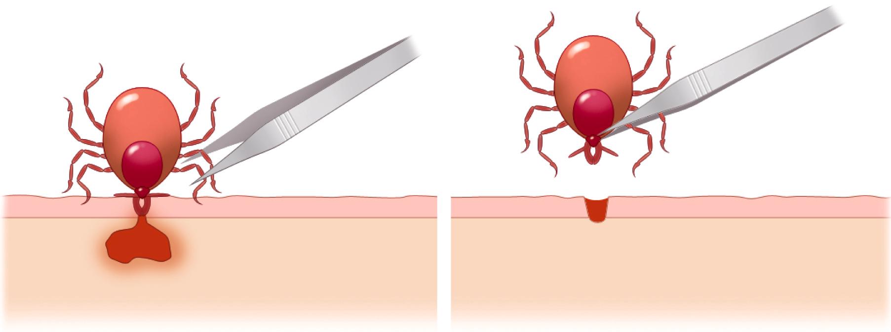 FIGURE 302-3, Tick removal technique.