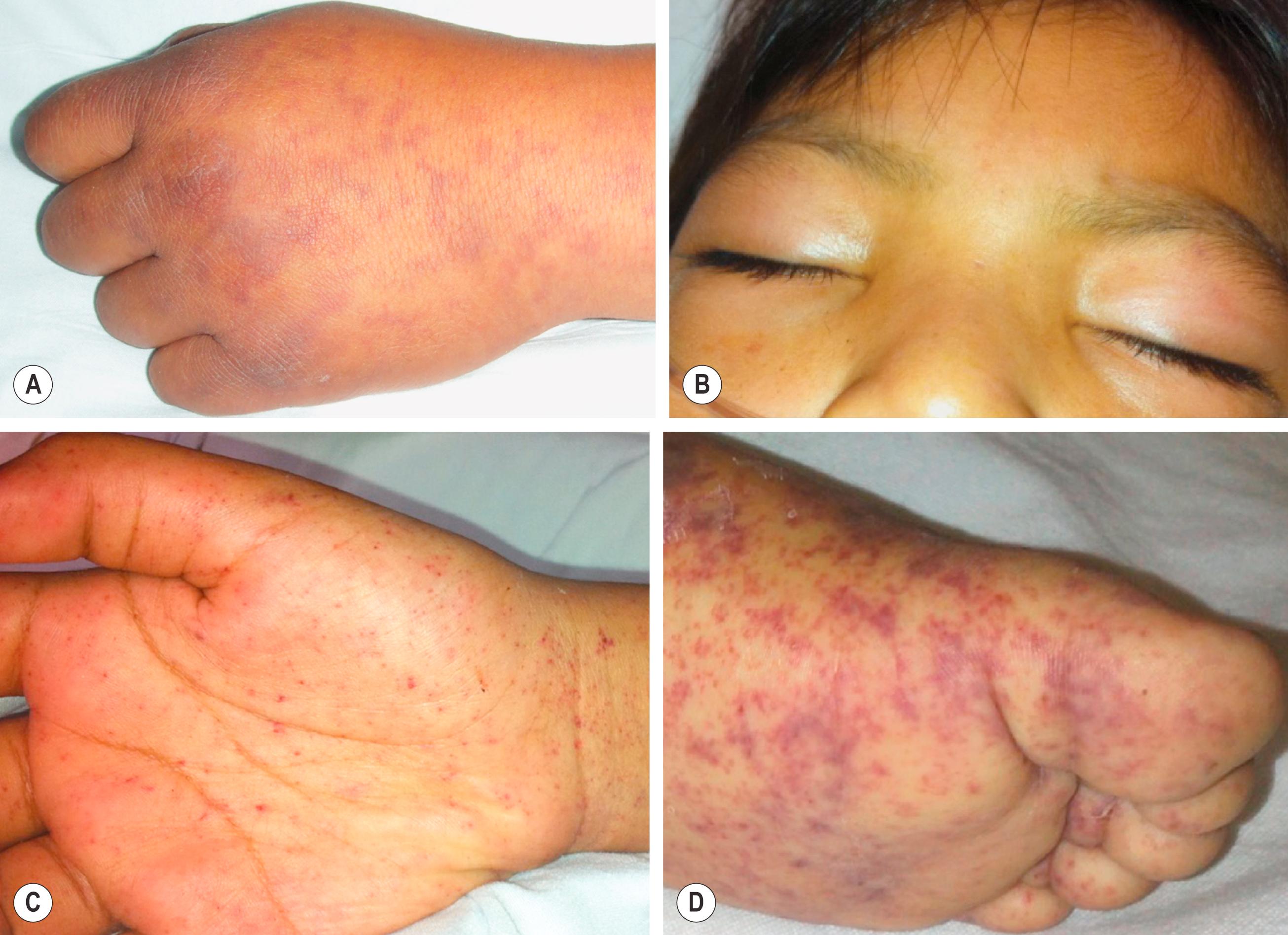 FIGURE 178.3, Clinical signs identified in children with Rocky Mountain spotted fever. (A) Edema of the dorsum of the hand. (B) Periorbital edema. (C and D) Petechial rashes involving the palm and sole.