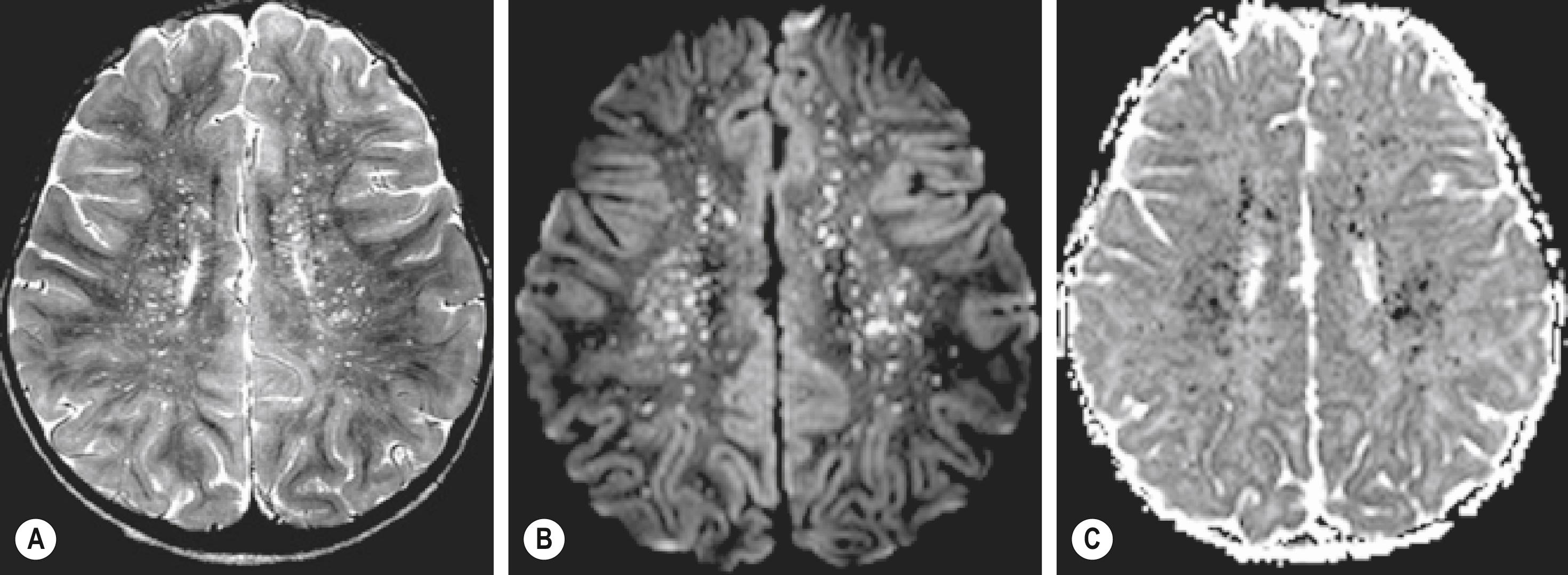 FIGURE 178.4, Axial MRI of the brain of a 2-year-old child with Rocky Mountain spotted fever and altered mental status. (A) T2-W MR demonstrating numerous, punctate, hyperintense foci scattered bilaterally in the subcortical and deep white matter in a perivascular distribution. (B) Diffusion-weighted image at same level as A showing increased signal corresponding to T2 white matter lesions. (C) Corresponding ADC map confirms restricted diffusion.