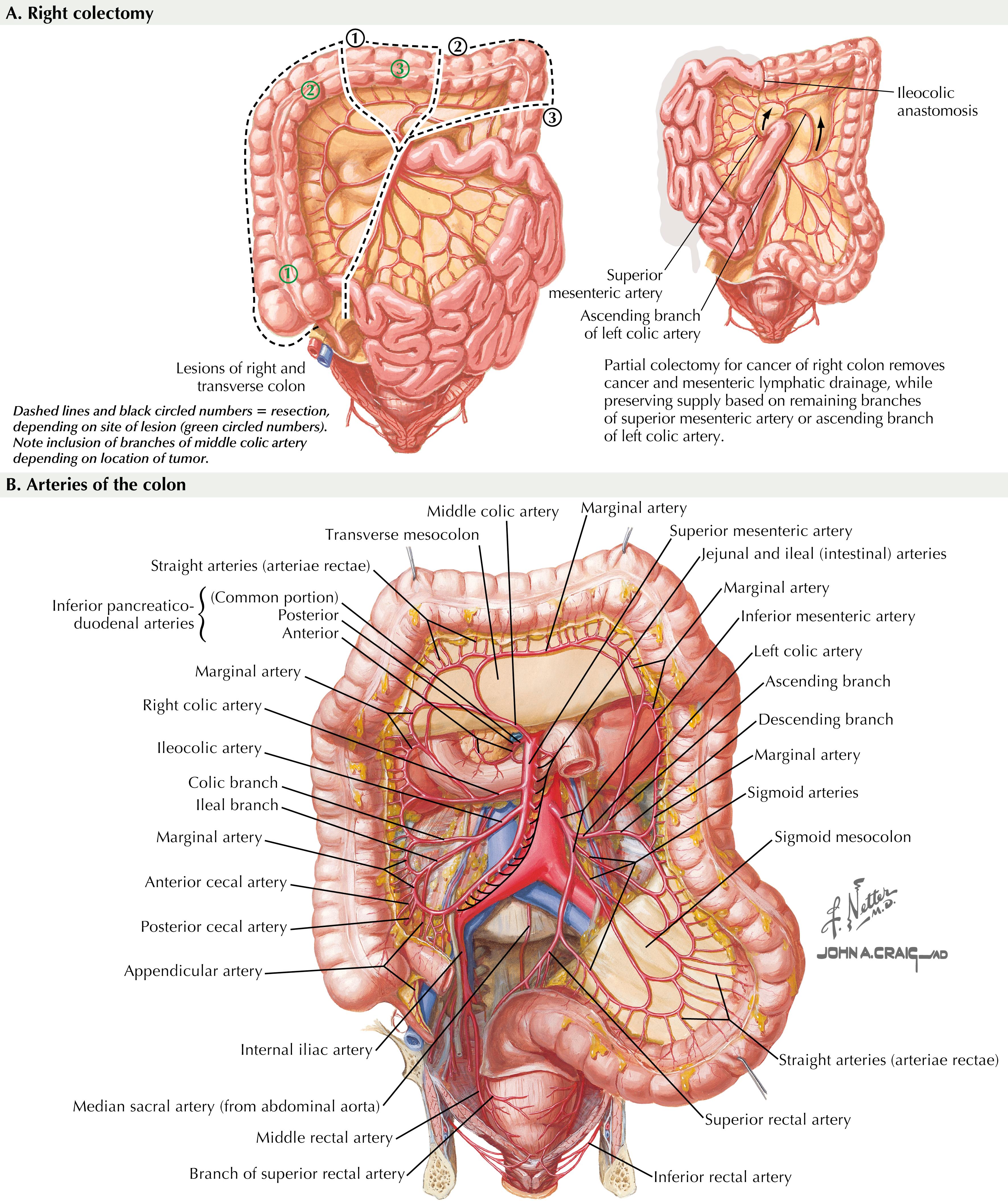 FIGURE 27.1, Right colectomy and arteries of the colon.