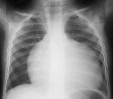 Figure 74.1, Classic radiographic appearance of Ebstein anomaly.