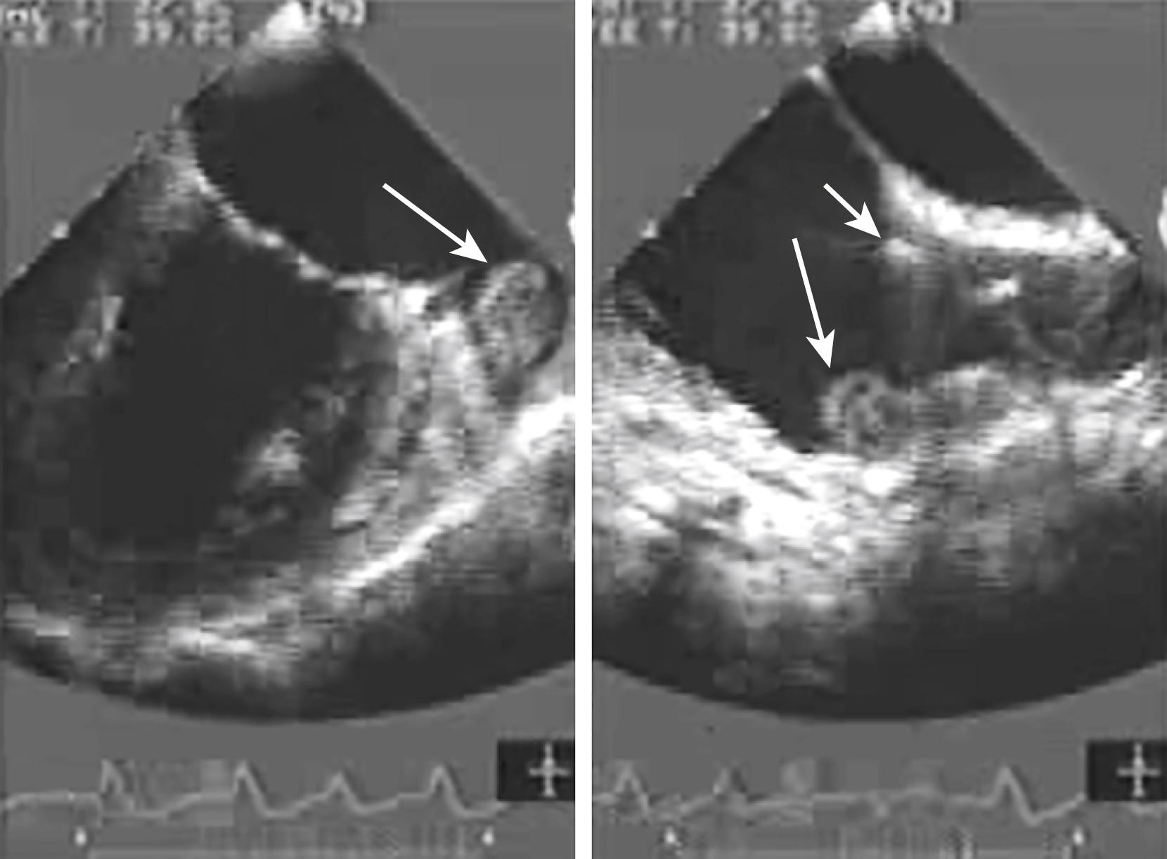 Figure 128.1, An early multiplane transesophageal echocardiographic examination (circa 1994), 90-degree orientation, performed for atrial fibrillation. Leftward rotation revealed a large thrombus (arrow) in the right atrial appendage. A linear echodense line seen entering the superior vena cava is a pacemaker wire (arrow). (See accompanying Video 128.1 .)