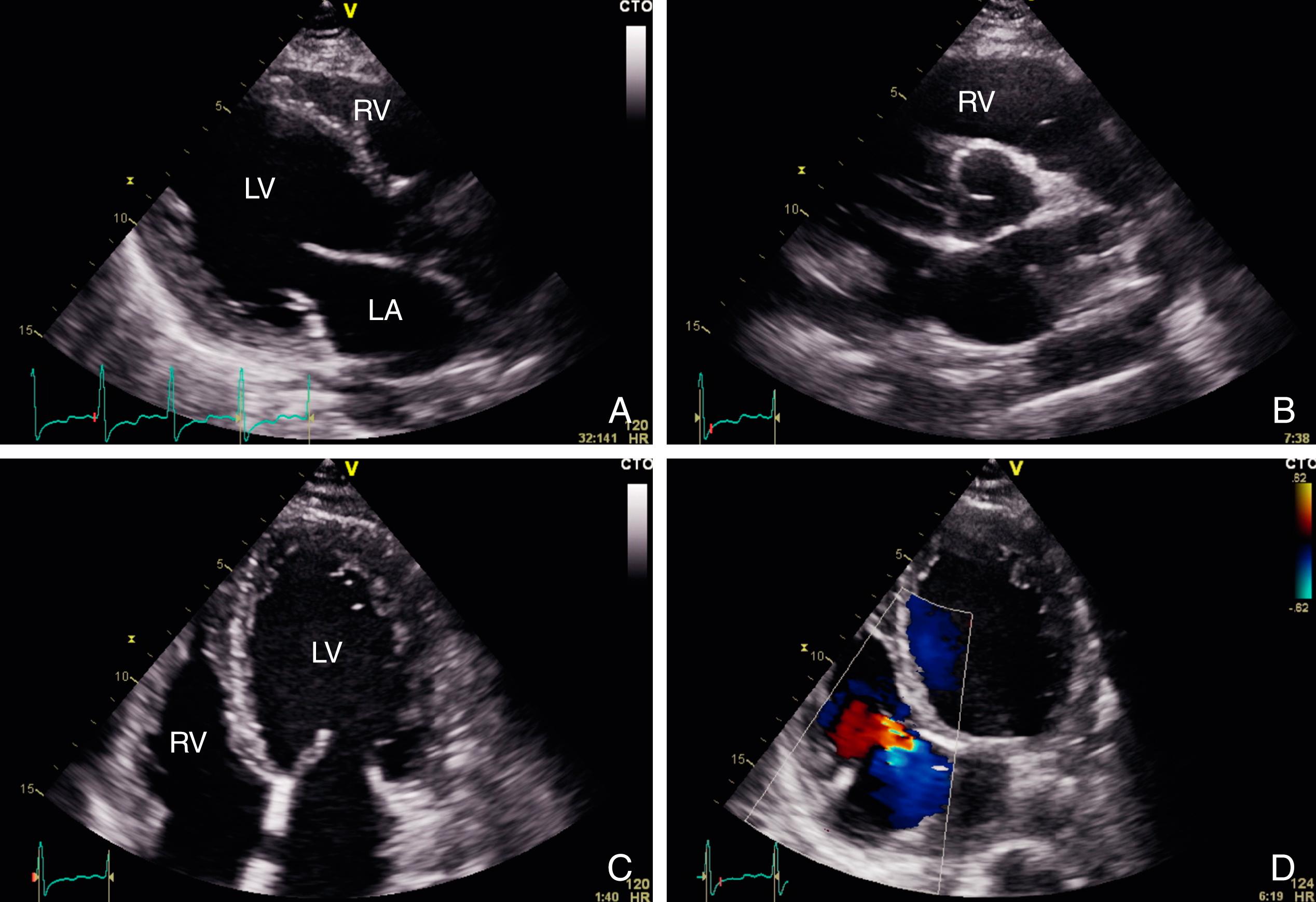 Figure 68.1, Standard echocardiographic views in a patient with a nonischemic dilated cardiomyopathy and biventricular dysfunction. A, Parasternal long-axis view. B, Parasternal short-axis view. C, Apical four-chamber view. D, Apical four-chamber view demonstrating tricuspid regurgitation. LA, Left atrium; LV, left ventricle; RV, right ventricle. (See accompanying Video 68.1A , Video 68.1B , Video 68.1C , Video 68.1D .)