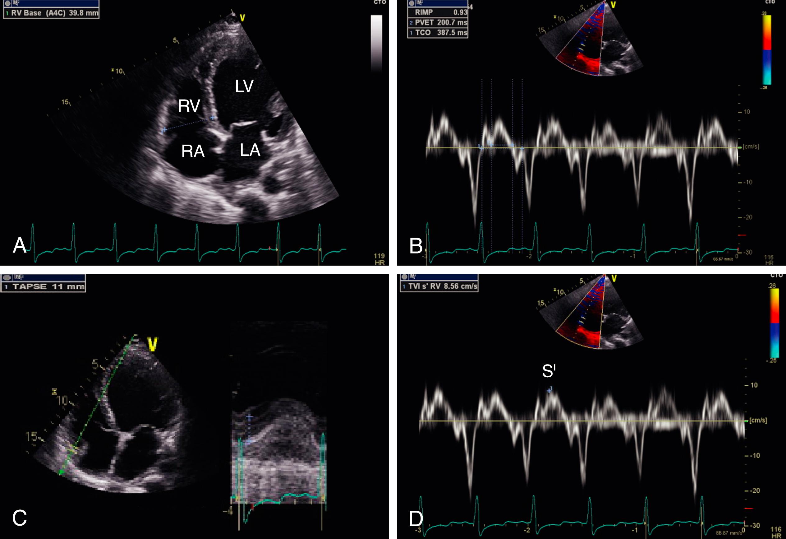 Figure 68.2, Methods to quantify right ventricular (RV) function in a patient with nonischemic dilated cardiomyopathy and biventricular dysfunction. A, Apical four-chamber view showing a basal RV dimension measurement. B, Tissue Doppler–derived RV index of myocardial performance. C, Tricuspid annular plane systolic excursion. D, Doppler S′ from pulsed tissue Doppler of the lateral tricuspid annular velocity. LA, Left atrium; LV, left ventricle; RA, right atrium.