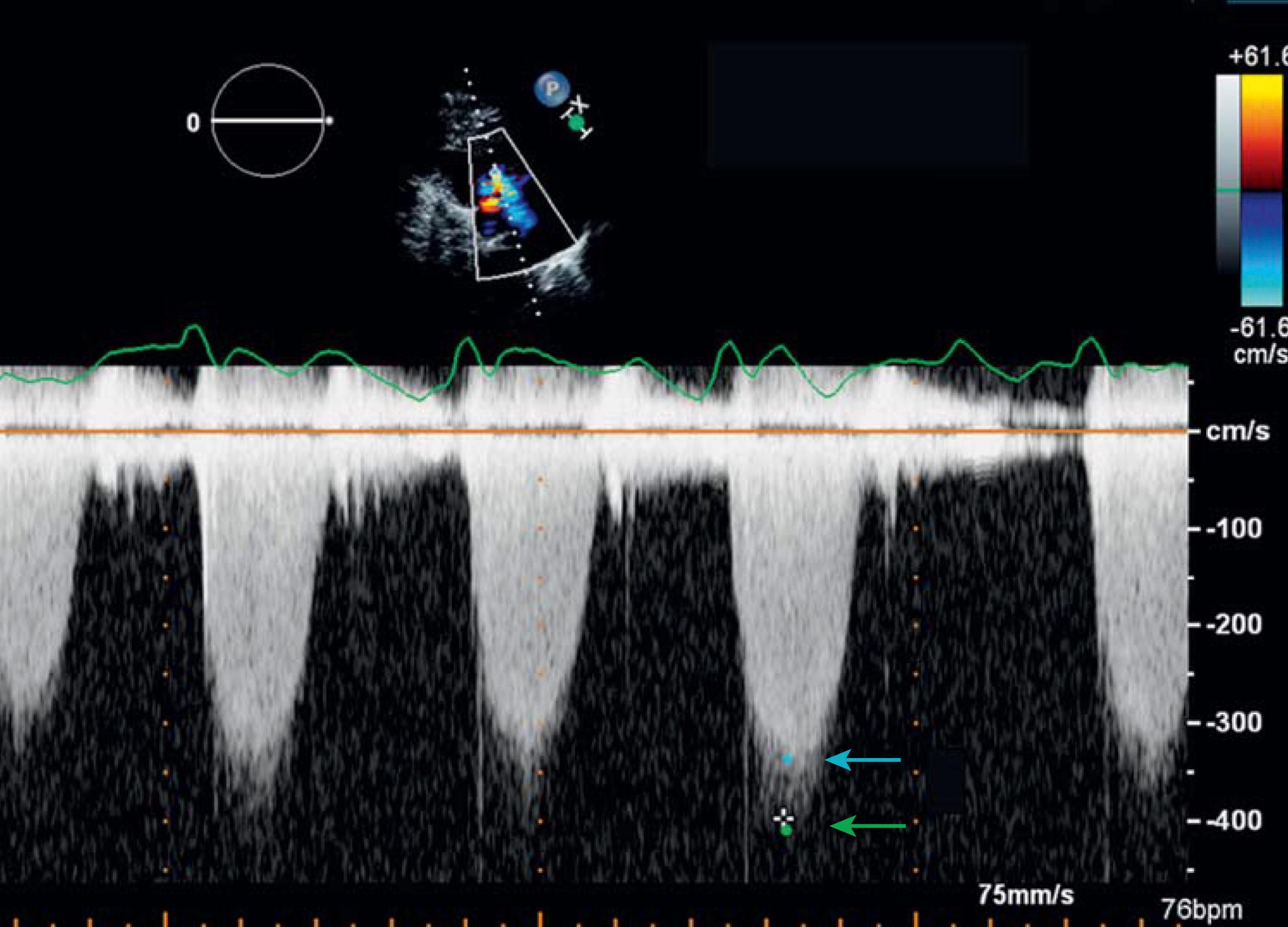 Figure 31.2, Continuous-wave Doppler tracing of a tricuspid regurgitant jet illustrating the preference of using the modal velocities (blue arrow) and avoiding the “fuzz” (green arrow) .