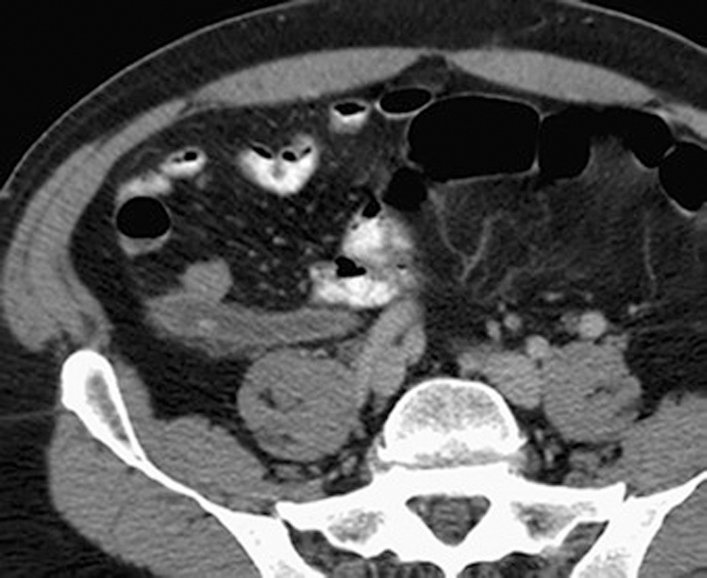 Fig. 11.2, Axial computed tomography scan of the pelvis showing a dilated, fluid-filled, inflamed appendix with an intraluminal appendicolith.