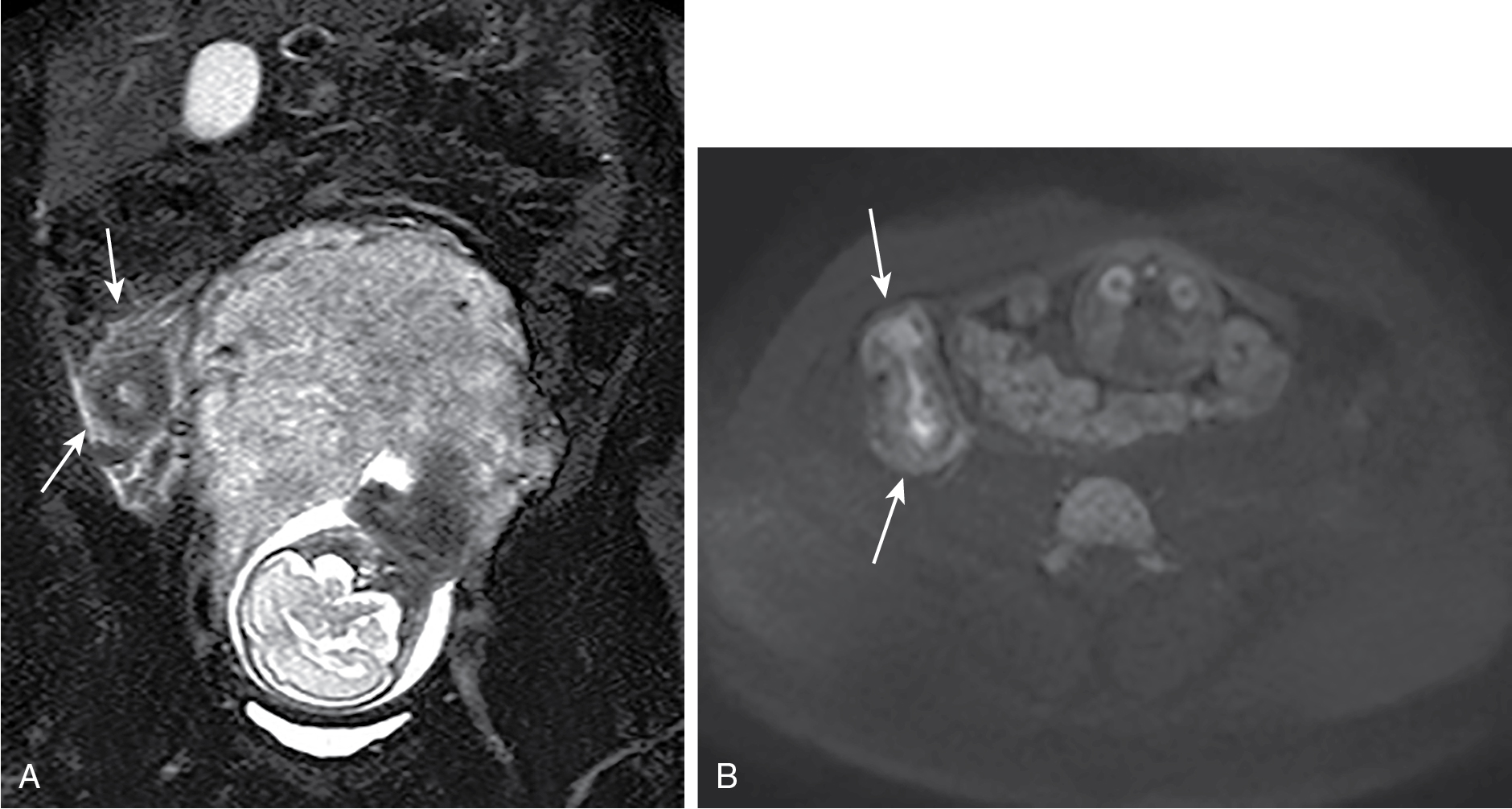 Fig. 11.4, Acute appendicitis in pregnancy. A, Coronal fat-suppressed T2-weighted image showing a thick-walled appendix with periappendical inflammation ( arrows ) in this pregnant patient. B, Axial diffusion-weighted image demonstrates intramural edema within the inflamed appendix ( arrows ).