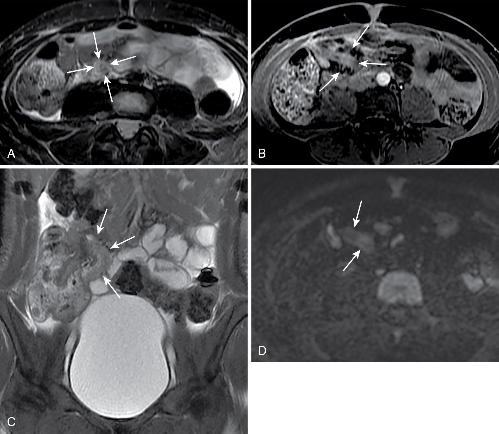 Fig. 11.5, Acute appendicitis. The axial, fat-suppressed, T2-weighted image (A) shows appendiceal edematous mural thickening ( arrows ) with intraluminal fluid and the corresponding fat-suppressed, T1-weighted postcontrast image (B) demonstrates abnormal appendiceal mural enhancement and periappendiceal inflammation ( arrows ). The coronal, fat-suppressed, T2-weighed image (C) shows the abnormally thickened appendix throughout most of its course ( arrows ). Diffusion restriction is evident in the diffusion-weighted image ( arrows in D).