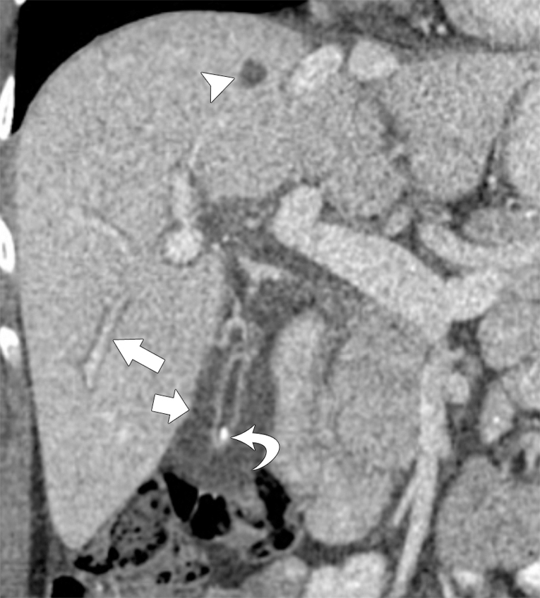 Fig. 10.2, Coronal contrast-enhanced computed tomography in a 36-year-old with acute viral hepatitis, mild hepatomegaly, portal tract edema ( arrow ), and diffuse gallbladder wall thickening ( small arrow ). An incidental simple hepatic cyst ( arrowhead ) and gallstone can be seen ( curved arrow ).