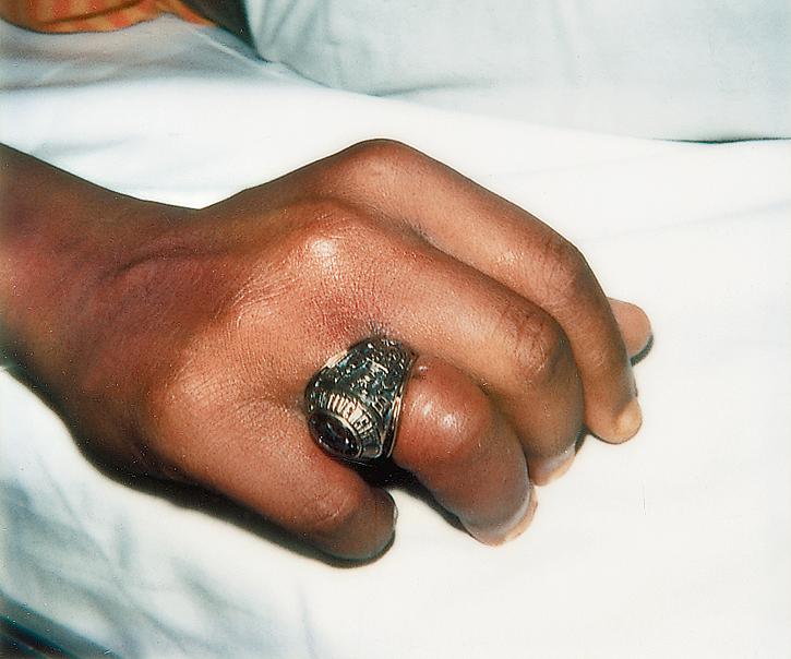 Fig. 152.1, Tight-fitting ring with secondary lymphatic obstruction and swelling.