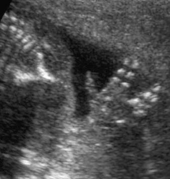 Fig. 140.1, Soft tissue syndactyly. Ultrasound image of a fetus at 18 weeks' gestation shows soft tissue syndactyly of the fourth and fifth fingers, which remained linked throughout the ultrasound examination, whereas the other fingers moved independently.