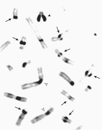 Fig. 140.2, C-banding of metaphase chromosomes. Arrows show selected chromosomes with premature centromere separation. Closed arrowhead points to “splitting” of the Y chromosome heterochromatic region. Open arrowheads show selected chromosomes with normal C-banded regions.