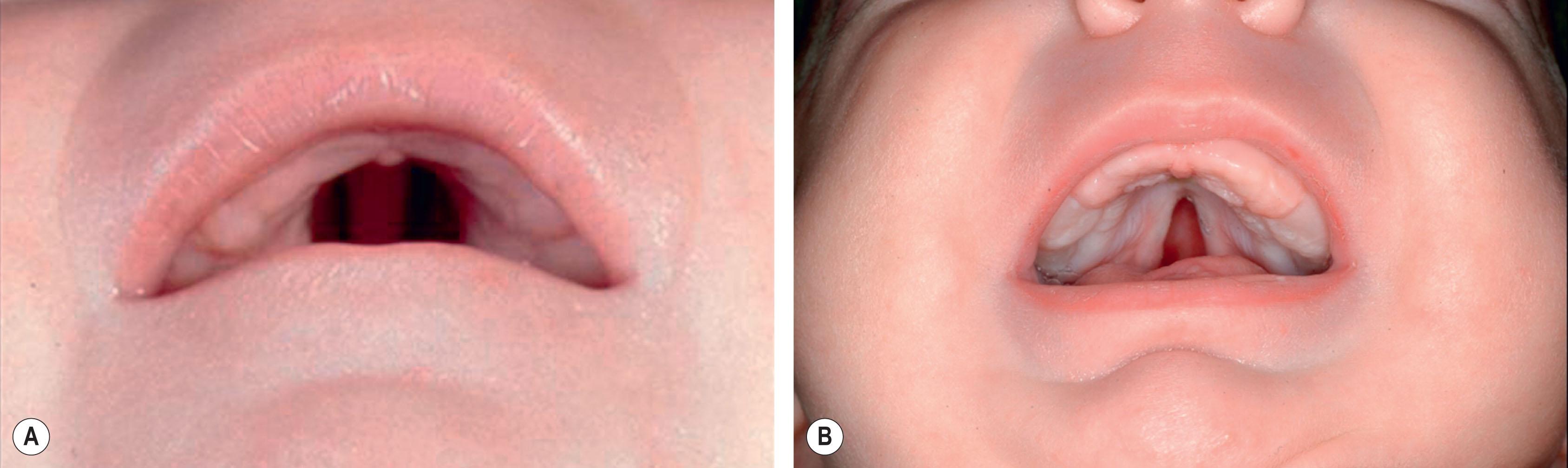 Figure 28.2, (A) This child with Robin sequence demonstrates the classic U-shaped cleft palate. (B) The cleft palate in Robin sequence may also take the form of a V.