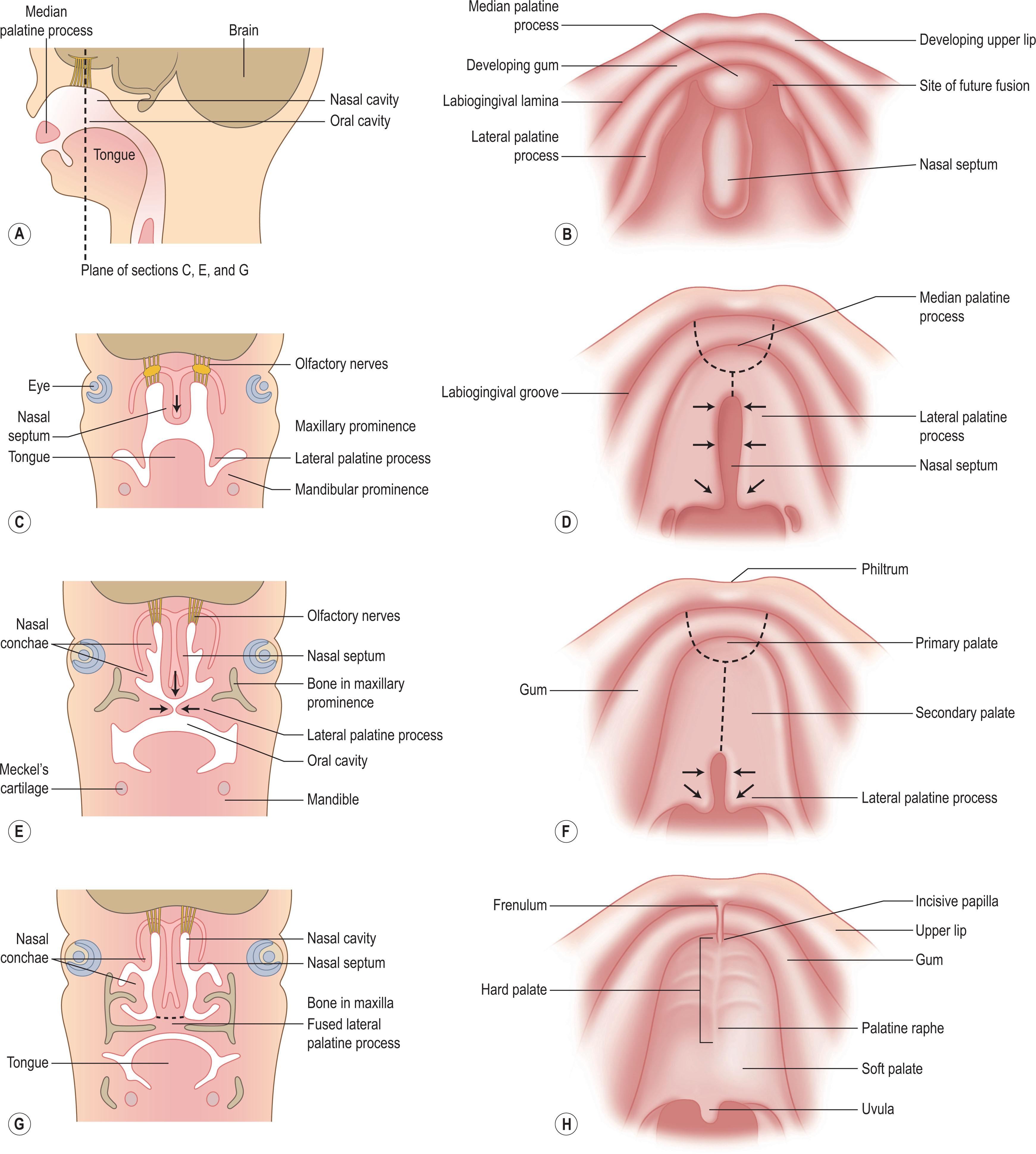 Figure 28.4, (A–H) The embryology of the tongue and palate is important for understanding the cleft palate in Robin sequence. The retropositioned tongue blocks the movement of the lateral palatine processes from a vertical to horizontal position.