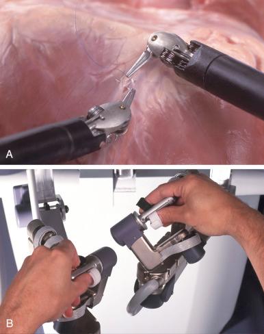 Figure 9.2, The surgeon controls the robotic arm (A) using two hand-operated mechanisms that reside within the surgeon console (B).