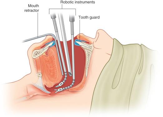 Figure 9.5, The set-up for transoral robotic surgery.