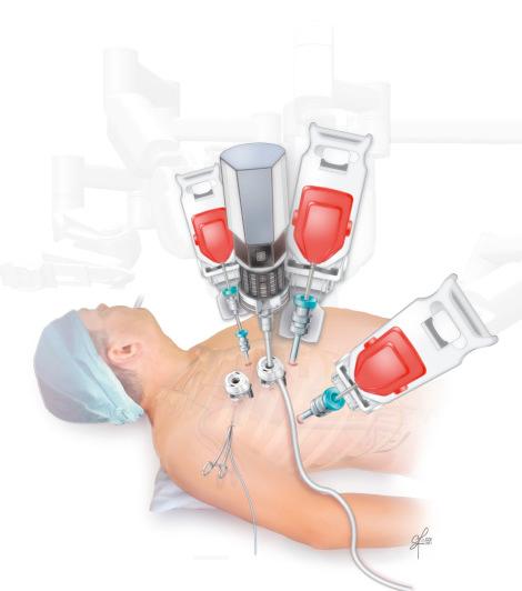 Figure 21.3, Patient setup and port placement.