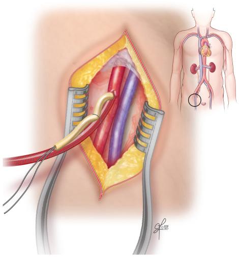 Figure 21.4, Cannulation of the femoral vessels.