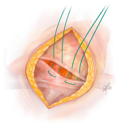 Figure 21.5, Opening of the precardium.