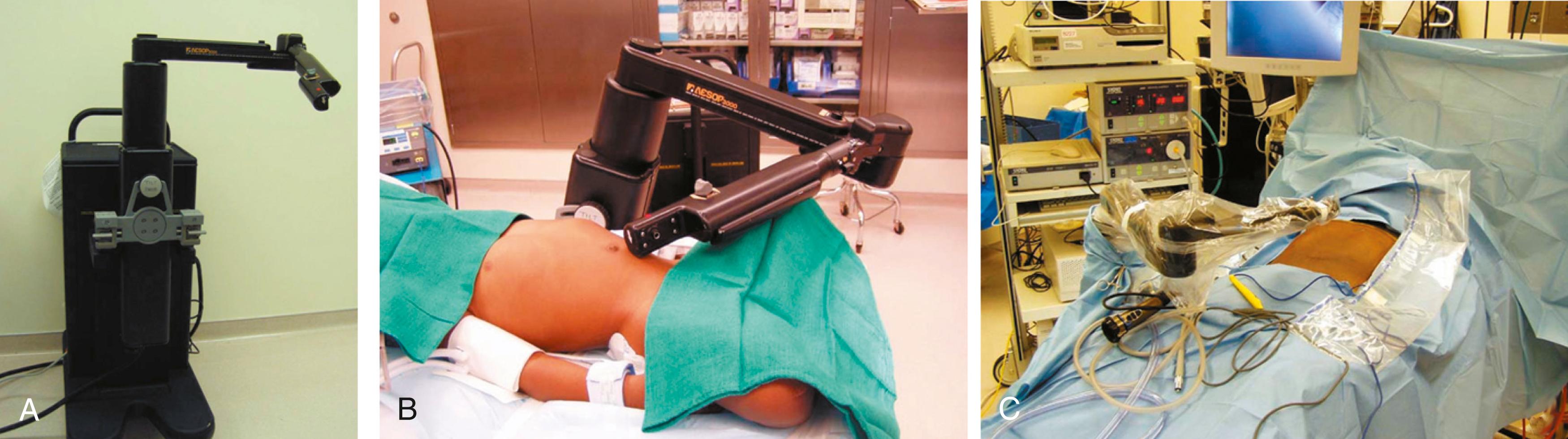 Figure 27-2, A, The AESOP robotic camera holder on its cart. B, The AESOP is positioned for a laparoscopic fundoplication in a young child. C, The AESOP is positioned for a laparoscopic cholecystectomy. This device provided a steady camera view and could be voice activated.