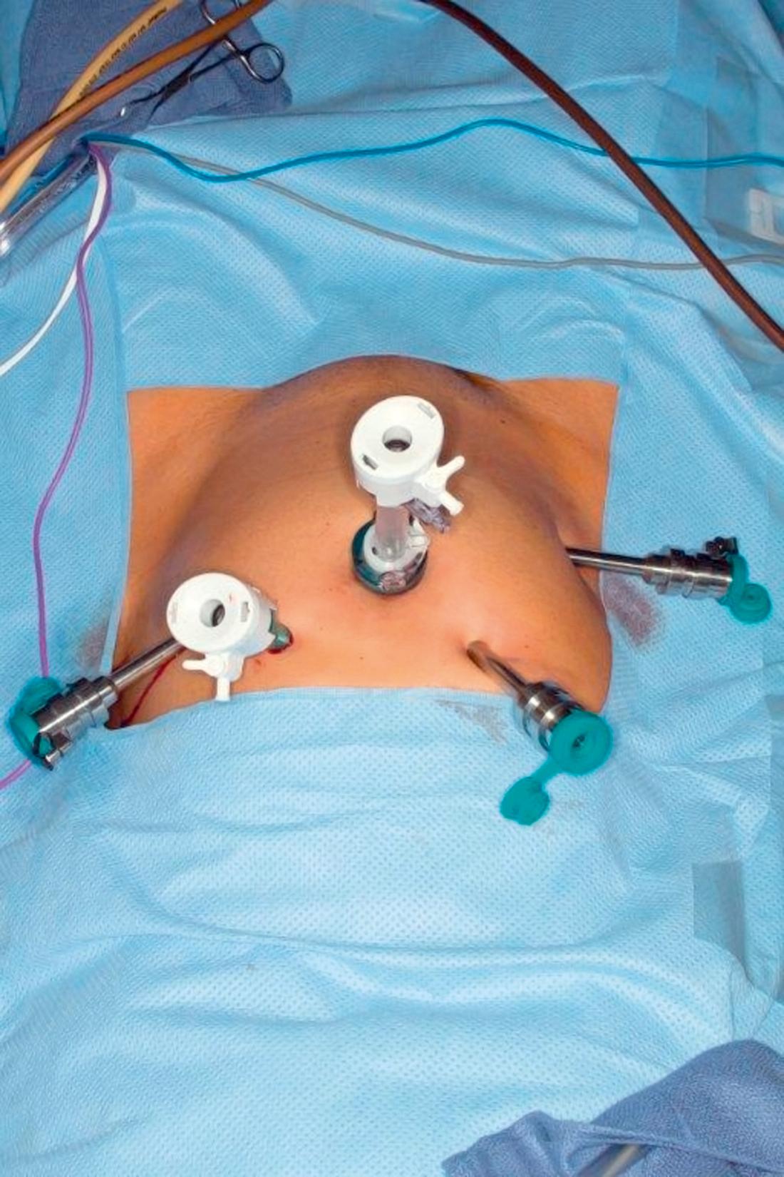 FIG. 118.7, Standard trocar placement for robotic pelvic operations. The patient’s head is at the lower aspect of the picture. Two robotic trocars are inserted at the level of the umbilicus, 12 cm to the right and left, respectively. A 10-mm assistant trocar is placed equidistant and 3-cm cranial between the umbilicus and the left robotic trocar. A fourth robotic arm, whenever used, is placed symmetric to the assistant trocar on the patient’s right side.