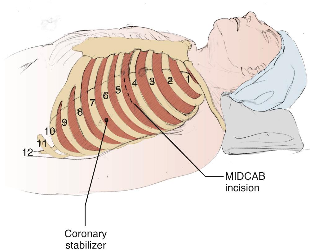 FIGURE 90-1, The limited left anterolateral thoracotomy for minimally invasive direct coronary artery bypass (MIDCAB) is approximately 5 to 7 cm, commencing in the midclavicular line in the fourth intercostal space. Also shown is the port placement for the endostabilizer, which can be used later for insertion of a chest tube.