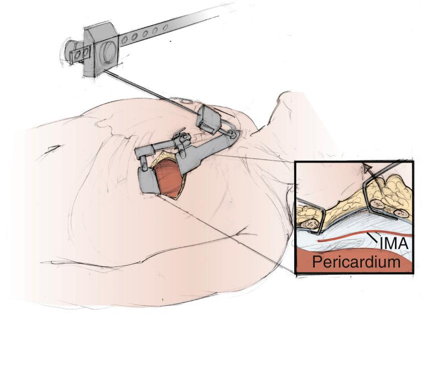 FIGURE 90-2, Specialized retractor setup for left internal mammary artery (IMA) harvest in minimally invasive direct coronary artery bypass (MIDCAB).