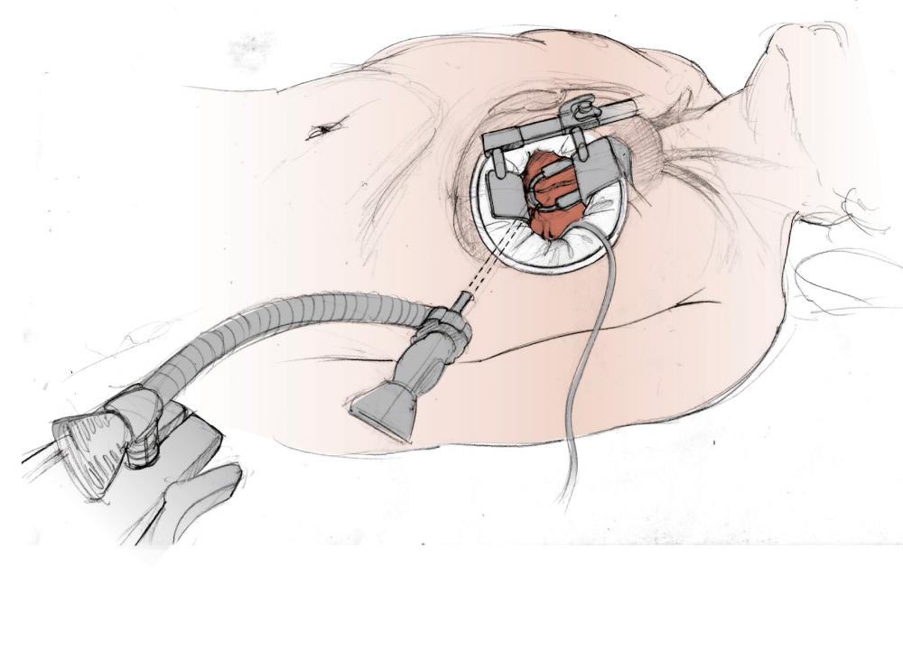 FIGURE 90-3, Endostabilizer has been inserted and left anterior descending artery is exposed for grafting. Note the presence of a soft tissue retractor to optimize visibility.