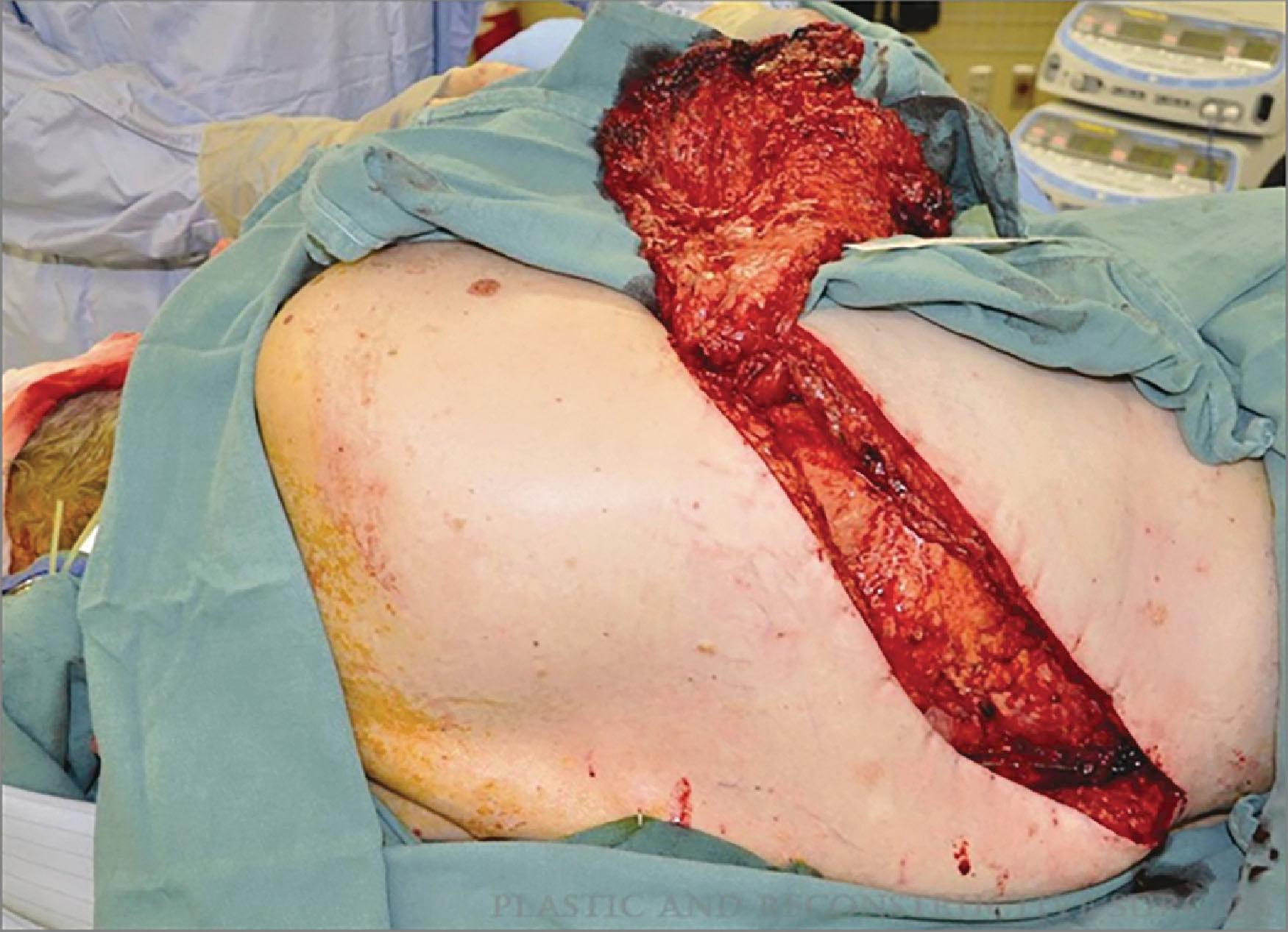 Figure 49.1, Traditional incision for harvest of the latissimus dorsi muscle can be very long, to access both the pedicle and the muscle origin.