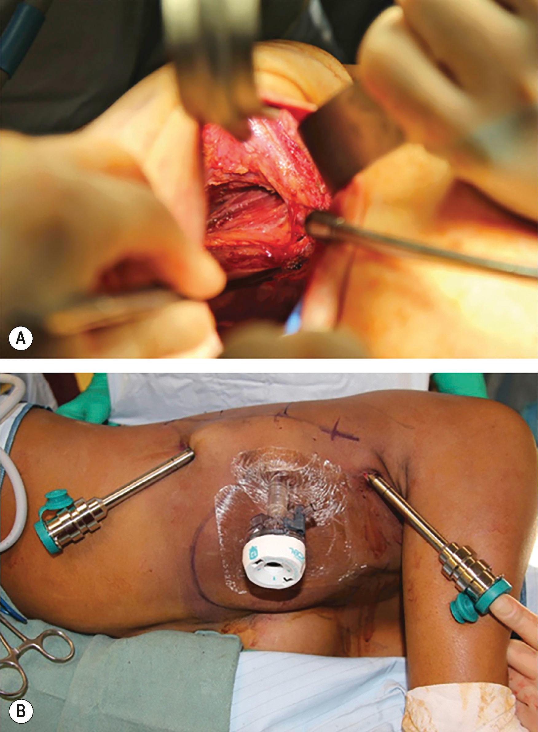 Figure 49.2, Intraoperative views during RALDH. (A) Pre-dissection of latissimus dorsi (LD) with exposure of thoracodorsal artery and vein. Note all dissection is accomplished through anterior mastectomy incision with no additional skin incisions required. (B) 12-mm and 8-mm ports are placed at the lateral border of the LD muscle.