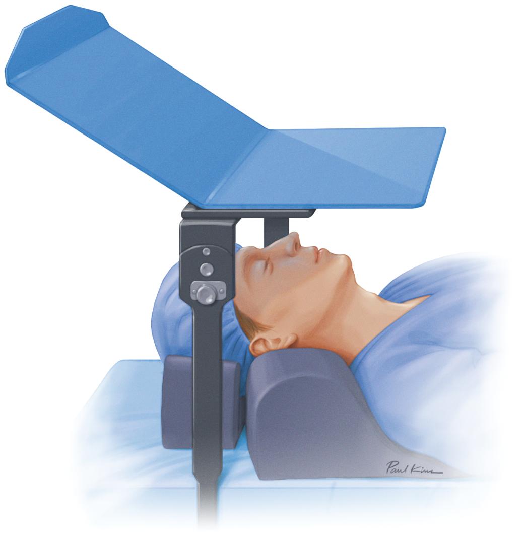 • Fig. 8.1, Use of sturdy coverage (blue “butler” tray) to protect the face during pelvic robotic surgery.