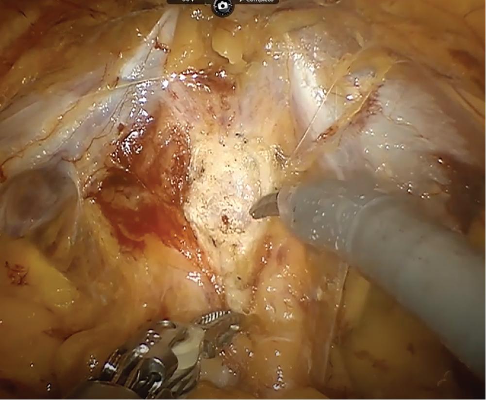 Fig. 17.3, Transverse Incision in the Anterior Vesicoprostatic Junction.